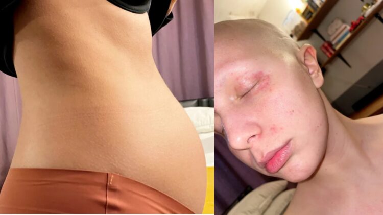 배가 점점 불러 임신한 듯 보였던 20대 여성이 여러 차례 오진 끝에 난소암 진단을 받은 사연이 전해졌다.사진=SNS