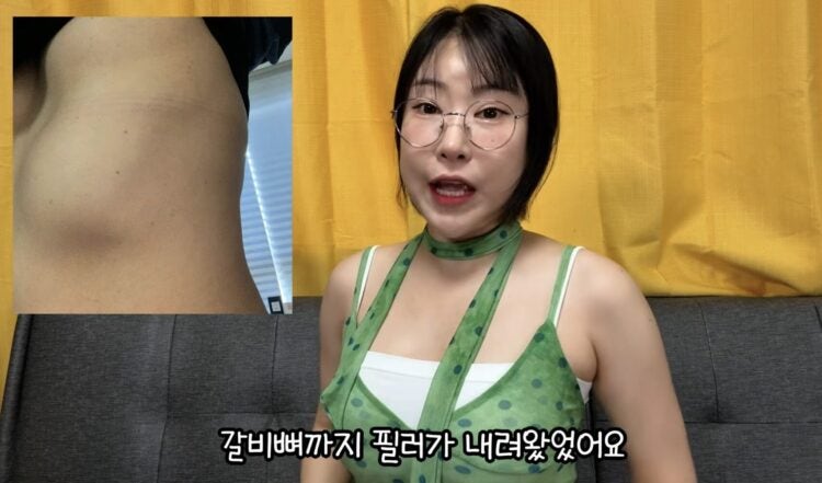 “필러가 갈비뼈까지 내려왔다”… 이세영 괴롭힌 가슴 필러 부작용, 뭐길래?