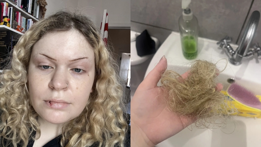 급성전골수구백혈병을 진단받은 로완 블랜드.왼쪽은 입술에 피 물집이 생긴 모습이며,오른쪽은 그가 공개한 빠진 머리카락이다.사진=SWNS