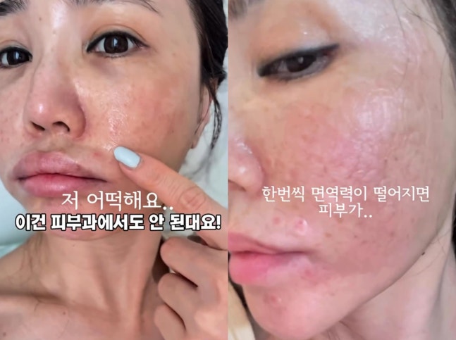 "저 어떡해요" 강예빈, 충격적인 피부 상태…얼굴 전체에 트러블, 피부과 소용없다