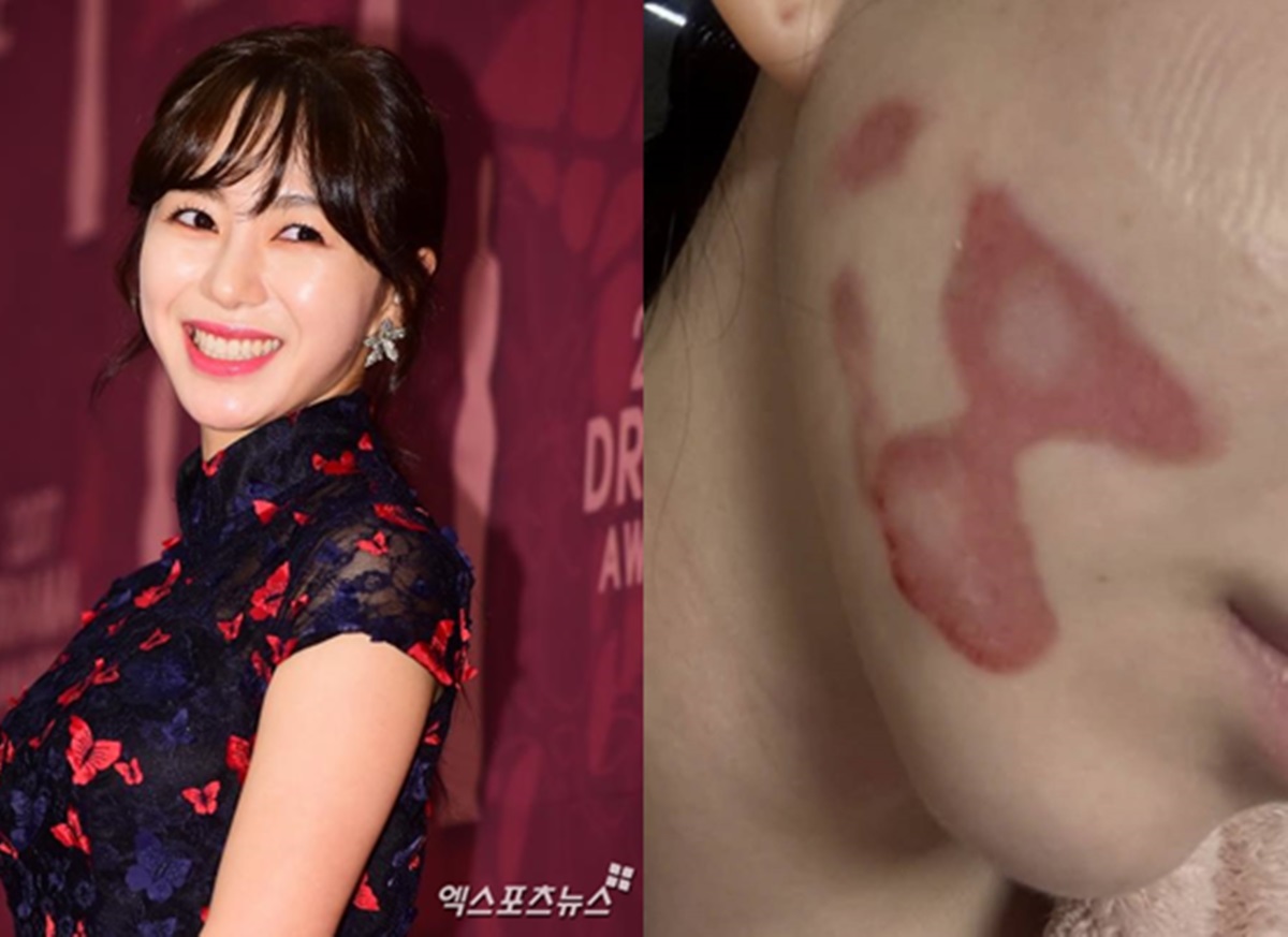 'AOA 출신' <b>권민아</b>, '화상 사고' <b>피부과</b> 녹취까지 공개…"내용증명에도...