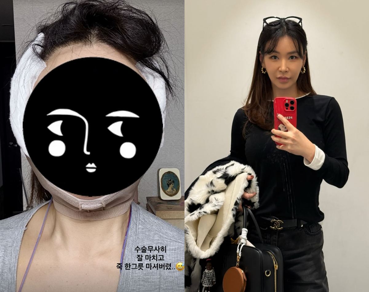 手術後に顔へ包帯と圧迫バンドを着けた姿と、自撮りを並べたペ・ユンジョンの写真