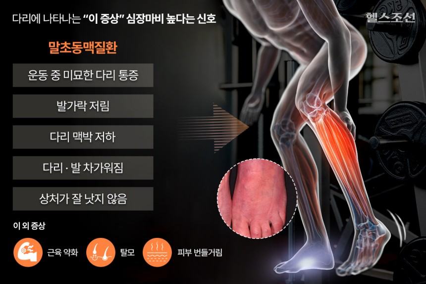 혈액에 콜레스테롤이 과도하게 쌓여 말초동맥질환이 생기면 발가락 저림, 발목 맥박 저하, 다리 통증 등의 증상이 나타난다./그래픽=김민선