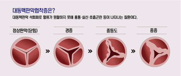 대동맥 판막 협착 정도에 따른 중증도 설명./사진=순천향대 부천병원 제공