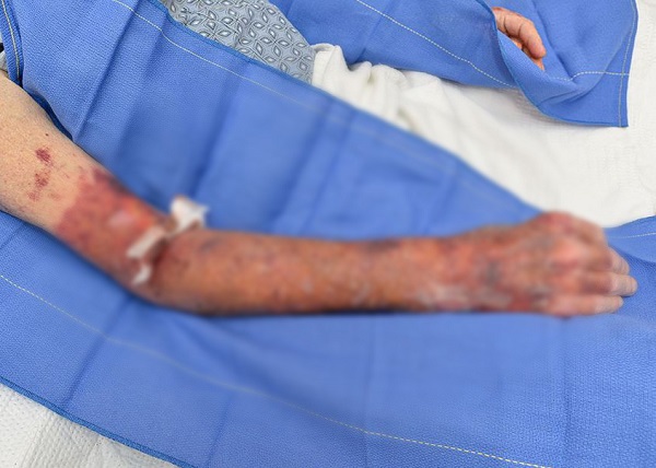 알코올에 중독됐다가 팔의 살가죽이 전부 벗겨진 미국 50대 남성 사진&#8203;/사진=Journal of Investigative Medicine High Impact Case Reports