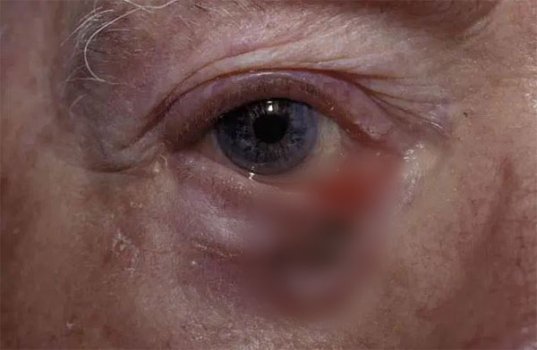 아래 눈꺼풀에 생긴 기저세포암./사진=미비전 안과 저널