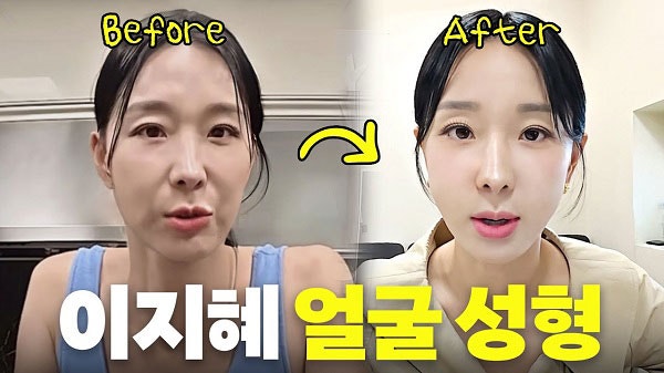 “얼굴에 ‘실’을 넣어 당긴다?” <b>이지혜</b>, 피부 ‘리프팅 <b>시술</b>’ 고백...