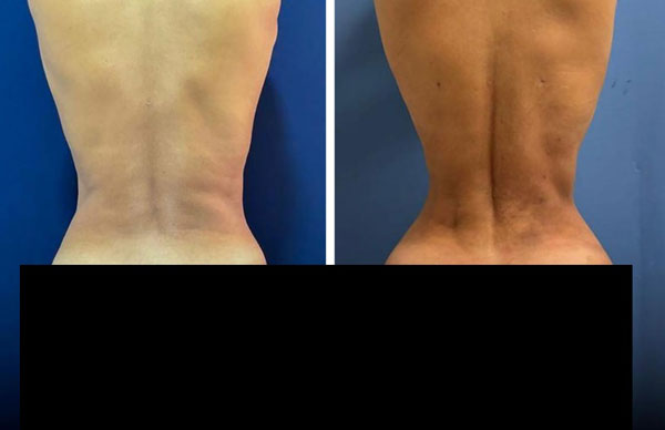 리브엑스카 수술로 허리 모양을 변형시킨 전후 사진./사진=성형외과 및 재건외과 - 글로벌 오픈