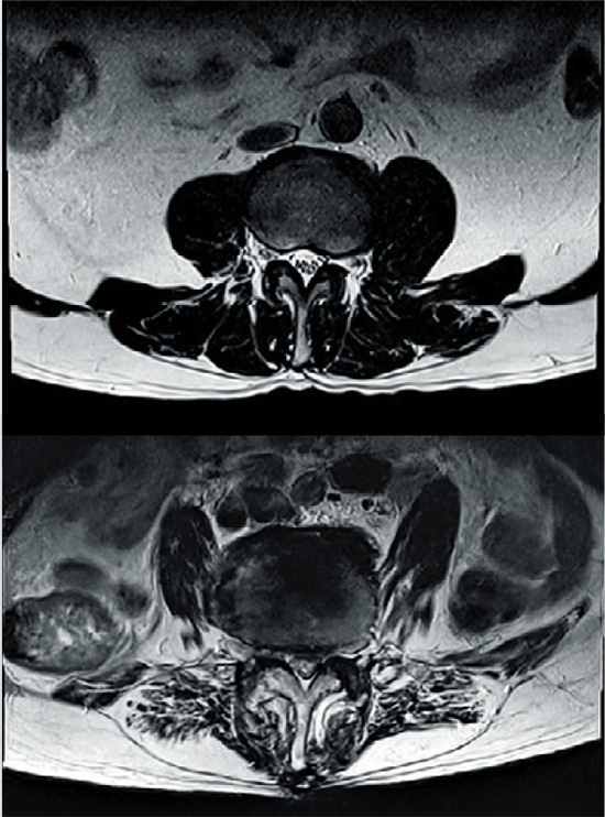 건강한 사람의 허리 근육(위)과 근육의 지방화가 일어난 허리 근육(아래) MRI 사진. /제일정형외과병원 제공