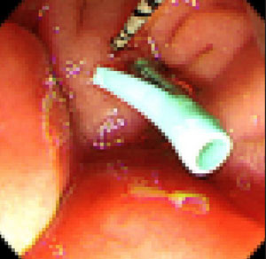극심한 복부 통증을 느낀 80대 남성의 대장에서 스텐트가 발견된 사례가 보고됐다./사진=큐레우스 