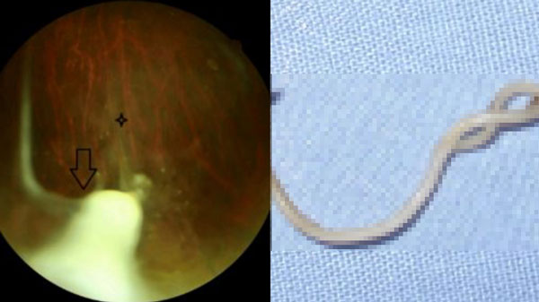 기생충 감염으로 시력이 저하된 남아의 사례가 보고됐다.왼쪽 사진은 남아 망막에 생긴 육아종의 모습이며 오른쪽 사진은 회충 사진이다.기사 사례와는 무관함./사진=큐레우스 