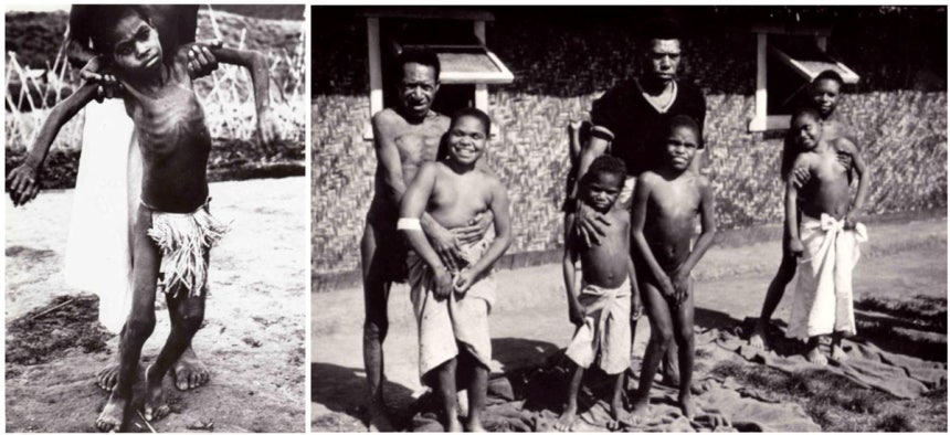 포어족에서 발견된 쿠루병은 식인을 매개로 전파된 프리온 질환이다./사진=tvN '책 읽어주는 나의 서재'캡처