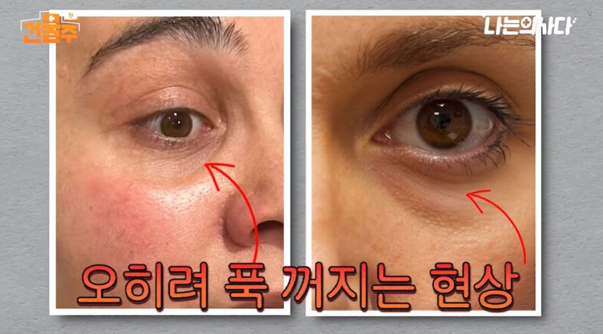 눈 밑이 불룩하게 튀어나온다고 해서 무작정 눈 밑 지방을 제거하기보다는 눈 구조와 노화 상태에 맞는 개선 방법을 찾아야 한다. /사진=유튜브 채널 '나는 의사다' 