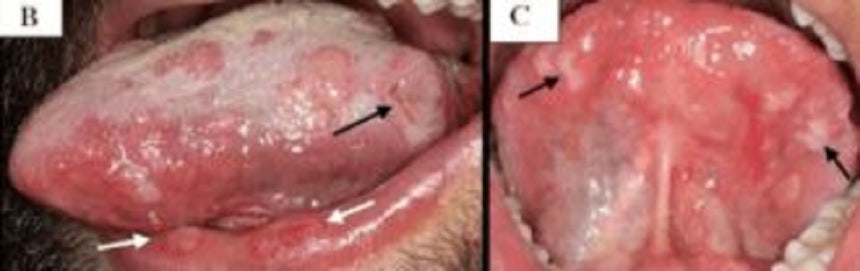 입안에 궤양이 올라온 20대 남성이 2차 매독을 진단받은 사례가 보고됐다./사진=큐레우스