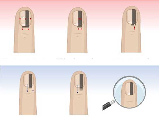 손발톱 흑색종 감별 임상적 기준 설명. 왼쪽은 진짜 흑색종인 경우고 오른쪽은 가짜 흑색종인 경우./사진=경북대병원 제공