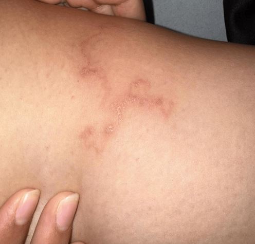 여행 후 피부 가려움증을 호소한 10대 여성이 피부유충이행증을 진단받은 사례가 보고됐다./사진=큐레우스
