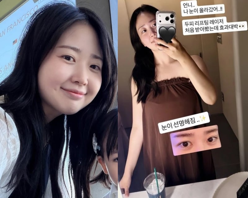 “효과 대박” 김다예, 얼굴 아닌 ‘의외의 부위’ 리프팅 받았던데?