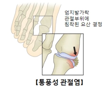 통풍성 관절염 /서울아산병원 제공