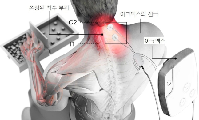 척수가 손상돼 사지마비된 환자가 손과 팔을 움직일 수 있게 하는 장치가 개발됐다. 수술을 하지 않고 피부에 장치를 붙이는 방식이라 훨씬 안전하고 간편하다. / EPFL, 네이처 메디슨