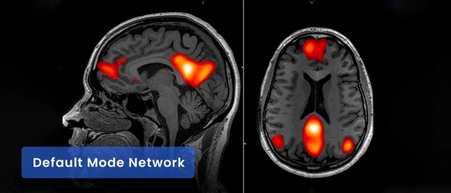 fMRI로 찍은 뇌의 '기본 모드 신경망(DMN)'. 영국 연구진이 이 영상으로 치매 발병 9년 전에 진단할 수 있음을 입증했다./미 월터리드 국립군의료센터