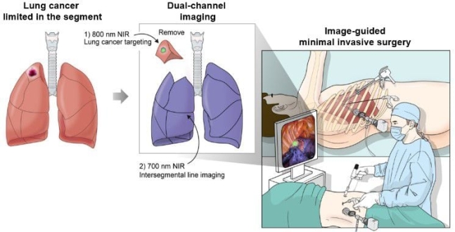 김현구 고대구로병원 심장혈관흉부외과 교수와 최학수 하버드 의대 교수 연구팀이 개발 중인 '이중 형광영상을 활용한 폐암 정밀 수술법'./고대구로병원