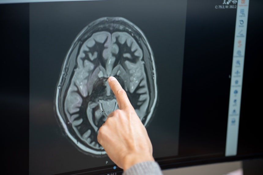 케이시 하펀 펜실베이니아대 의과대학 교수가 환자의 뇌 컴퓨터단층촬영(CT)에서 측좌핵을 가리키고 있다./미 펜실베이니아대 의과대학