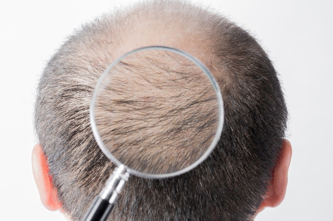 탈모를 방지·지연할 수 있는 생활 습관이 주목된다.<BR> 사진은 기사 내용과는 무관함. /사진=이미지투데이