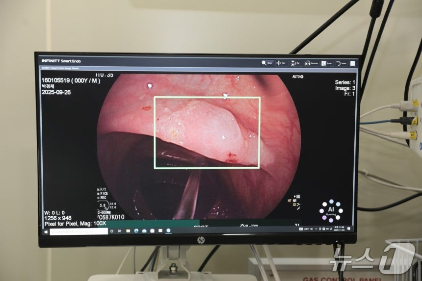 대장내시경 검사를 할 때 AI(인공지능)를 활용하면 선종 검출률을 높일 수 있다는 연구결과가 나왔다. 사진은 AI 보조 대장내시경 모습.(한림대학교동탄성심병원 제공)