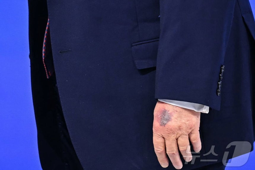 22일(현지시간) 스위스 다보스에서 열린 세계경제포럼(WEF) 연차총회(다보스포럼)에 참석한 도널드 트럼프 미국 대통령의 왼손 손등에 멍이 들어 있다.2026.01.22.ⓒ AFP=뉴스1 ⓒ News1 윤다정 기
