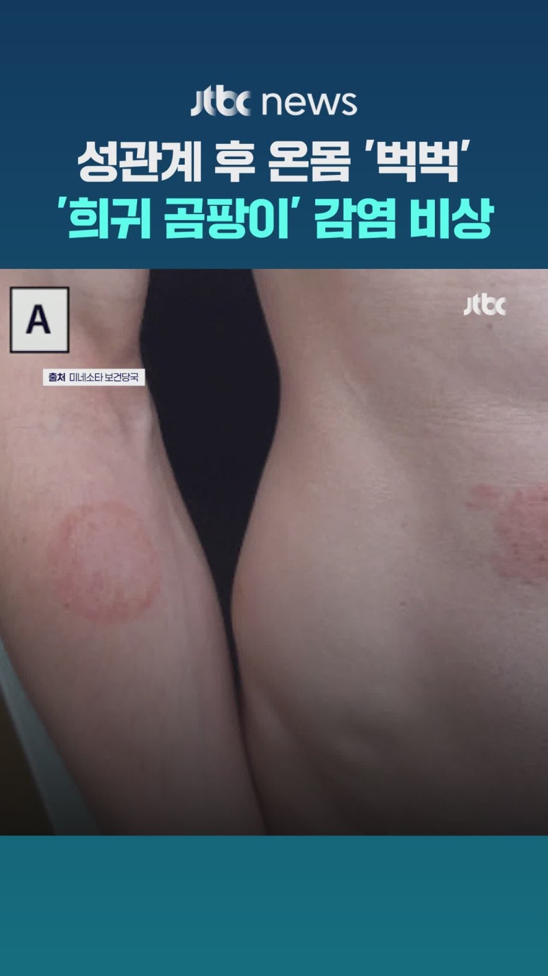 성관계 후 '희귀 곰팡이' 감염…미국서 확진 잇따라 '비상'