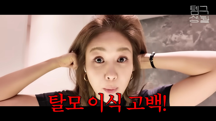 <b>옥주현</b>, “<b>모발 이식</b> 후 잔머리 사라졌다”…시술 <b>부작용</b> 고백