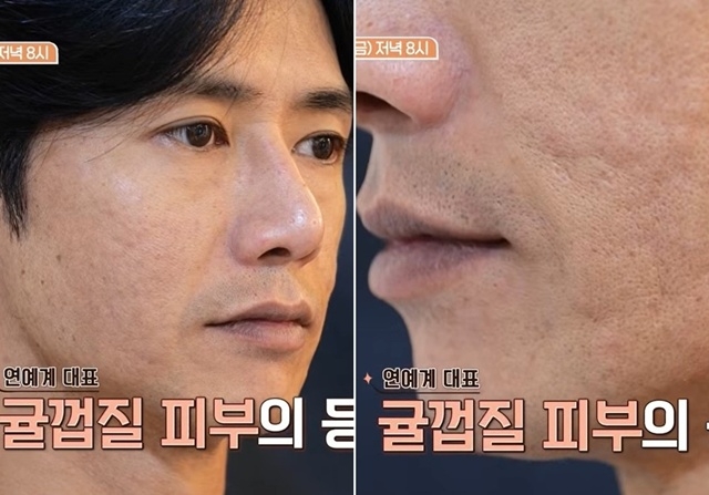 “식도 녹고 온몸 수포” <b>오종혁</b>, 간수치 800까지…달라진 피부에 충격