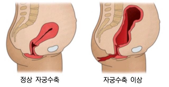 자궁수축 부전에 따른 산후출혈. 서울아산병원