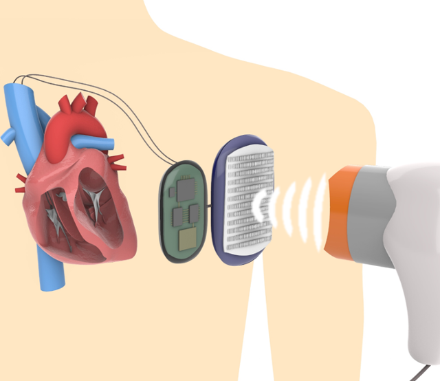체내 이식형 심장박동기의 초음파 무선 충전 개념도. 한국과학기술원(KIST) 제공