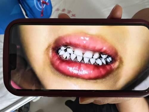 중국 간쑤성의 한 유치원에서 납중독이 의심되는 유치원생의 치아 일부가 검게 변해 있다. 중국 지무뉴스 캡처
