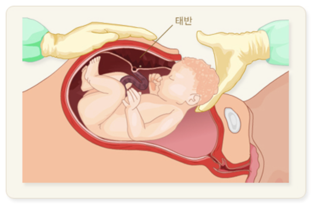 [기억할 오늘] 한국의 기이한 제왕절개 분만 비율