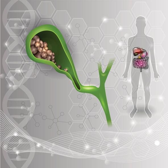 살 빼려다 쓸개 잃을라… 무리한 다이어트가 담석증 부른다