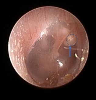 하얀 진주 같은 이름 뒤 숨은 위험… 아이 청력 위협하는 ‘진주종’