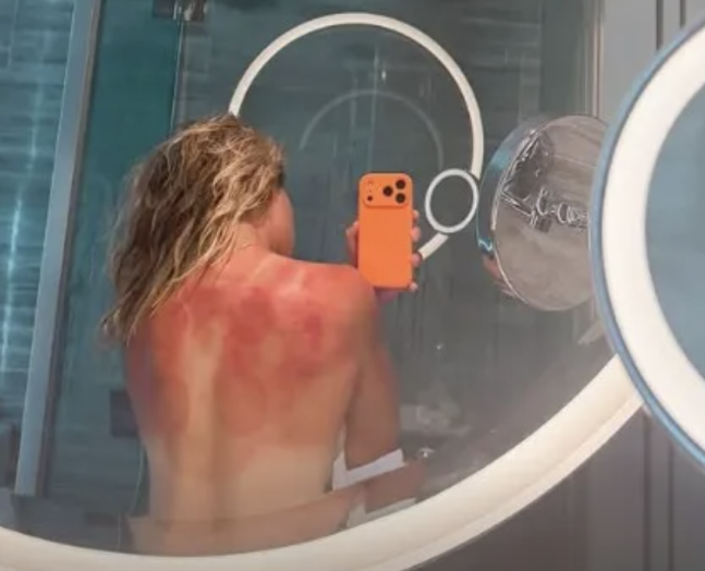 한국인 최다 여행 검색 국가…테니스 선수 끔찍한 햇볕 화상 자국→상반신 탈의 공개 "태양이 장난 아니다"