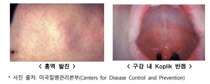 홍역 확진자에게 나타날 수 있는 발진과 반점 증상.질병관리청 제공