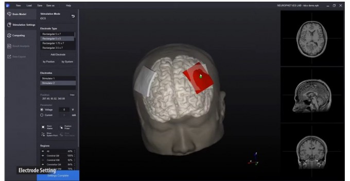 뇌 수술 환자에게 경두개직류자극 치료를 적용하는 시뮬레이션 장면.서울성모병원 제공.