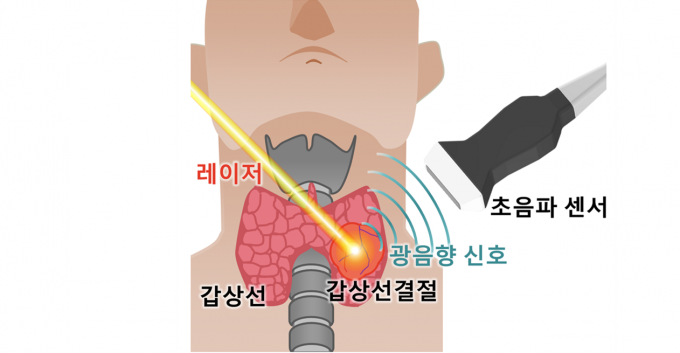 레이저로 갑상선 결절에 광음향 신호를 발생시키고 초음파 센서로 광음향 신호를 획득하는 모식도. 포스텍 제공.