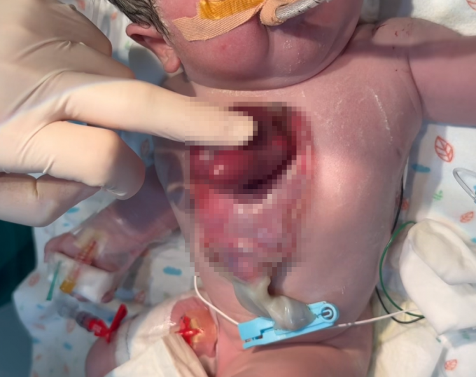 4월 10일 심장이소증을 안고 태어난 박서린 양의 전흉부 모습.서울아산병원 제공