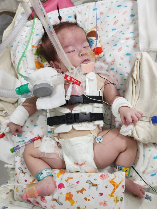 9월 3일 양측 흉곽을 모아주기 위해 3D 프린팅으로 제작한 맞춤형 흉부 보호대를 착용하고 있는 박서린 양의 모습.서울아산병원 제공