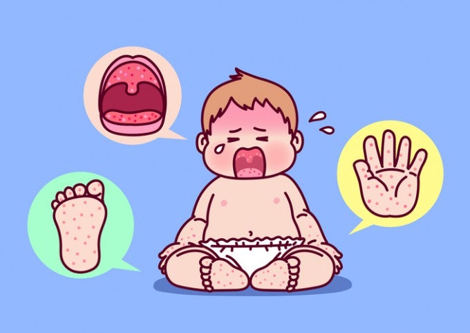 한 달 새 수족구병 2.2배 증가…"완전 회복 후 등원해야"