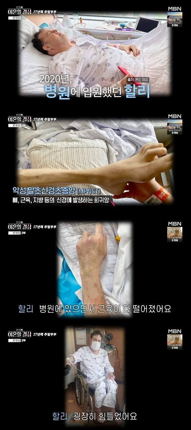 <b>로버트 할리</b>, 마약 파문 후 <b>희귀암 투병</b>‥앙상한 다리+퉁퉁 부은 얼굴 ...