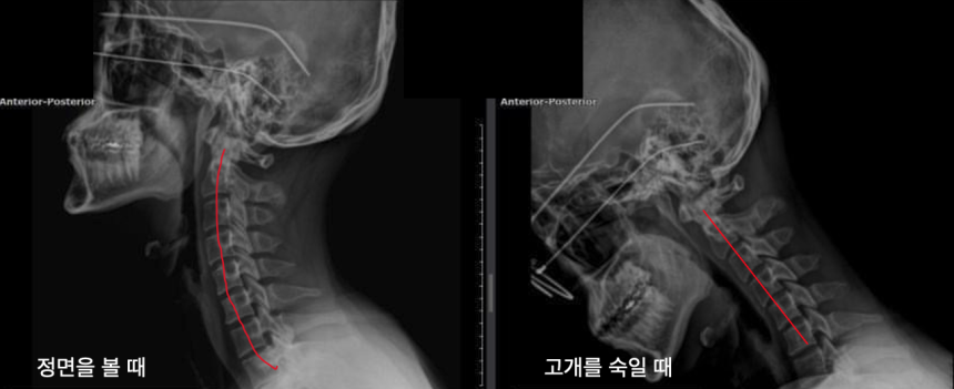 일자목을 악화시키는 습관