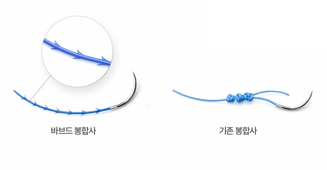 분당서울대병원 산부인과 김기동 교수팀은 매듭 없이도 조직을 고정할 수 있는 바브드 봉합사의 임상 적용 가능성을 평가하는 연구를 했다‘바브드 봉합사’(왼쪽)와‘기존 봉합사.분당서울대학교병원