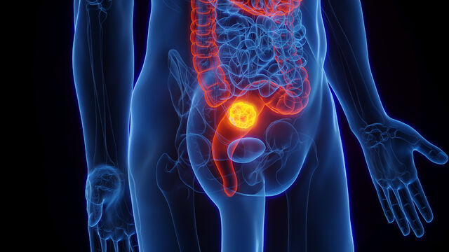 직장암 수술 없이도 완치 가능? 4년 생존율 100% 연구 결과!