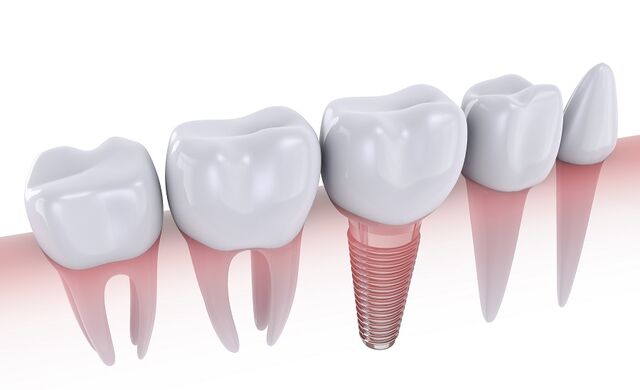 송재민 부산대학교병원 구강악안면외과 교수는 "“작은 어금니나 앞니는 임플란트 두께보다 좁아지는 경우가 있어 좌우 자연치를 손대지 않고 시술하려면 1년 안에 하는 것이 좋다”고 말했다.클립아트코리아